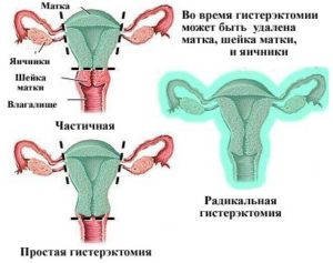 Нужно ли принимать гормоны после удаления матки и яичников