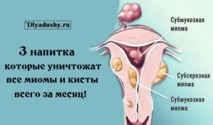 Чем миома отличается от кисты