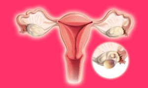 Дисфункция яичников репродуктивного периода