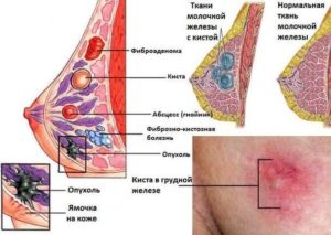 Матка боровая при фиброаденоме молочной железы