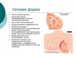 Узловая форма рака молочной железы