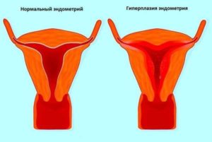 Как остановить кровотечение при эндометриозе