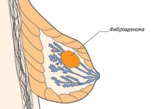 Может ли фиброаденома молочной железы перерасти в рак