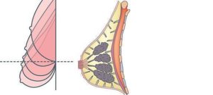 Псевдоптоз молочных желез