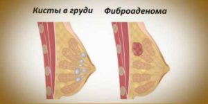 Как избавиться от кисты в молочной железе