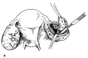 Лапароскопическая клиновидная резекция яичника
