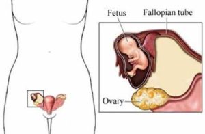 Болит левый яичник при беременности на ранних сроках