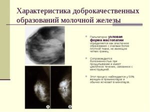 Доброкачественные образования молочной железы