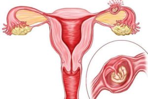 Внематочная беременность в яичнике