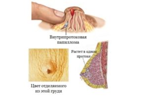 Внутрипротоковая папиллома молочной железы