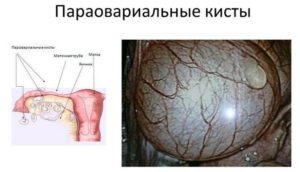 Параовариальная киста яичника лечение без операции