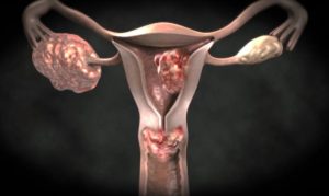 Опухоли матки и яичников симптомы