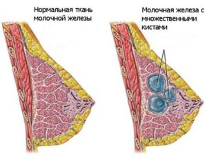 В молочной железе стреляет