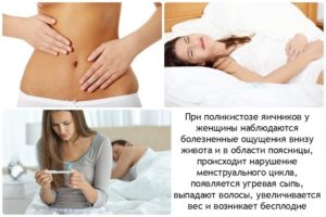 Фолиевая кислота при поликистозе яичников