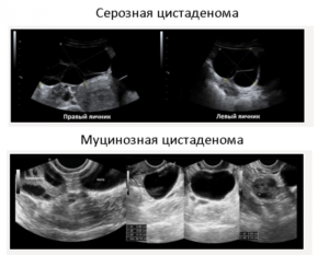 Серозная цистаденома яичника что это такое