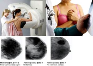 Что лучше узи или маммография молочной железы после 45