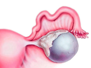 Фолликулярная киста яичника лечение народными средствами