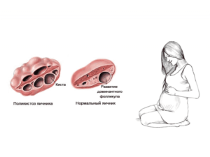 Поликистоз яичников как лечится