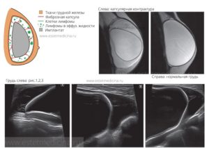 Контрактура импланта молочной железы