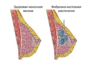 Болит молочная железа при надавливании сбоку