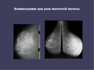 Маммография рак молочной железы