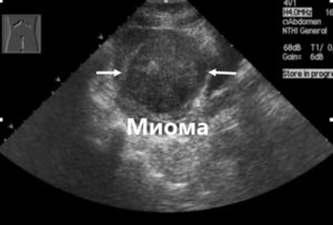 Миома матки в стадии регресса при климаксе