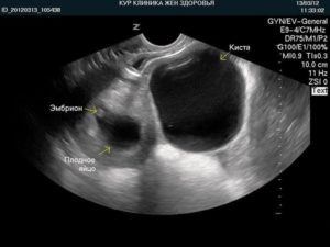 Может ли киста яичника рассосаться сама