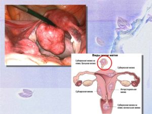 Миома яичника что это