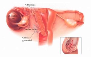 Узловая миома матки в сочетании с эндометриозом
