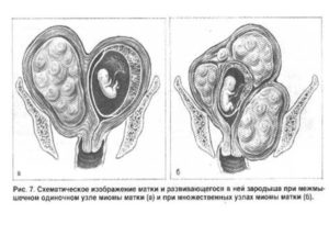 Можно ли забеременеть при миоме матки небольших размеров