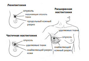 Операции при раке молочной железы