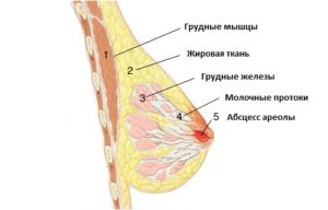 Воспаление протока молочной железы