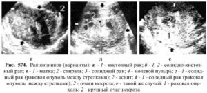 Как выглядит на узи рак яичника