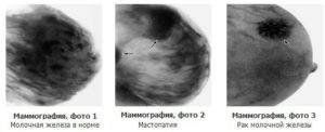 Когда нужно делать маммографию молочных желез