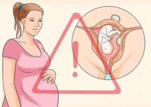 Миома и беременность совместимы