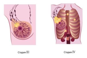 Третья стадия рака молочной железы