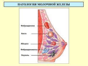 Абсцесс молочной железы