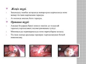 Эндометриоз причины психологические