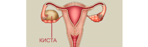 Как вылечить кисту яичника