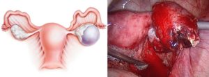Киста яичника последствия после операции