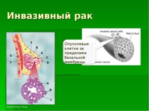 Инвазивный рак молочной железы