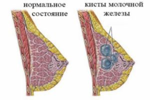 Воспаление кисты молочной железы лечение