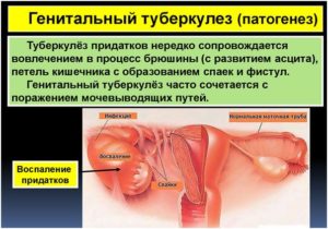 Туберкулез яичников у женщин