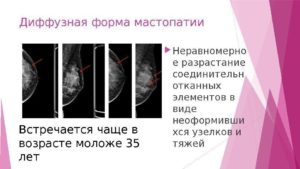 Диффузный фиброз молочной железы
