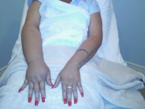Отек руки после операции на молочной железе