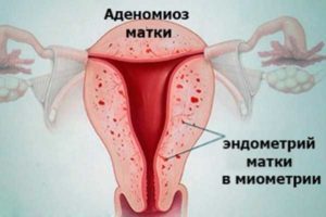 Признаки миомы матки в сочетании с эндометриозом