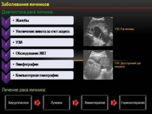 Диагностика рака яичников у женщин