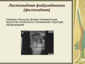 Филлоидная фиброаденома молочной железы