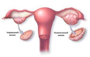 Пересадка яичников у женщин