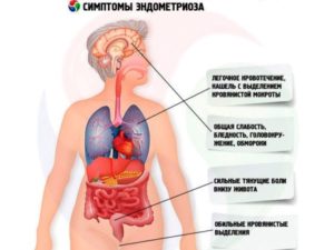 Эндометриоз при климаксе симптомы и лечение